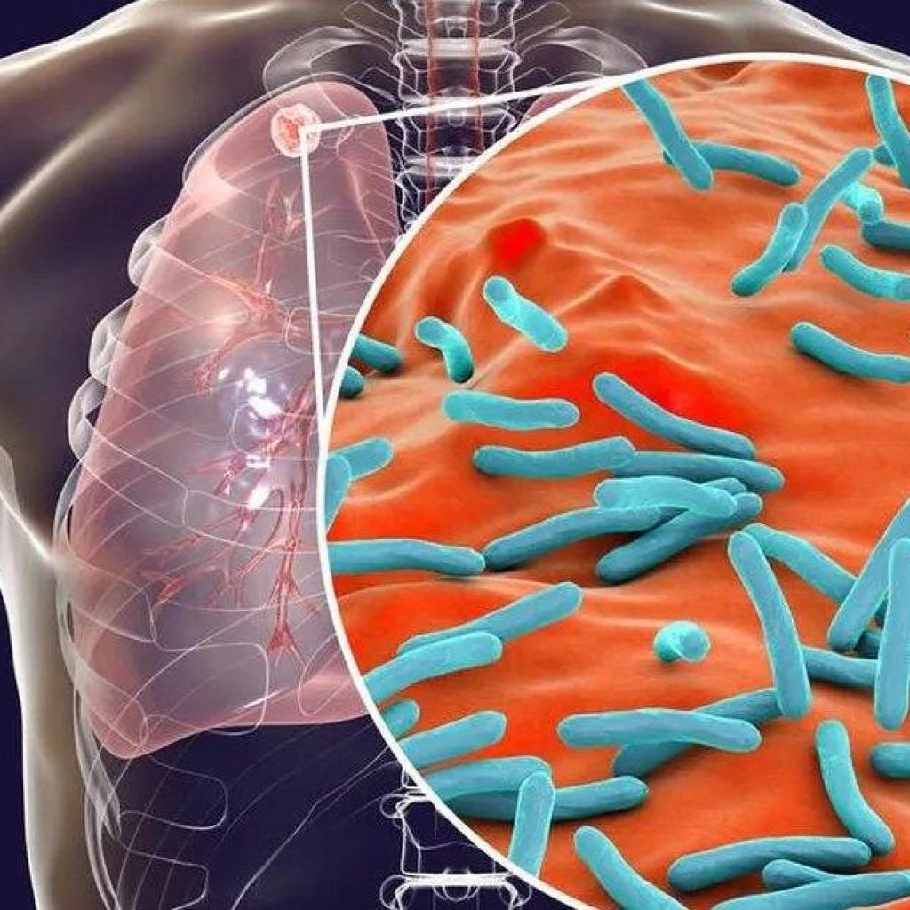 Onderzoek wijst op aanhoudende tekortkomingen bij aanpak tuberculose