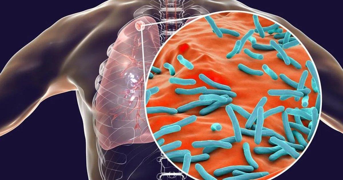 Onderzoek wijst op aanhoudende tekortkomingen bij aanpak tuberculose